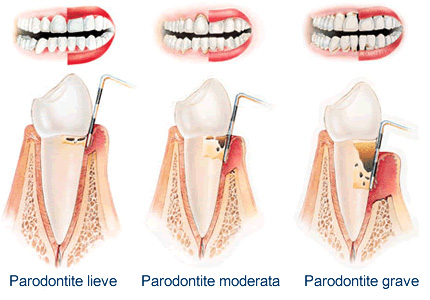 parodontite